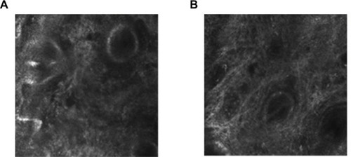 Figure 1 Photographs of dermis with confocal reflectance microscopy.Notes: (A) Initial. (B) After 90 days of use. Observe greater parallelism of more evident collagen fibers in B.