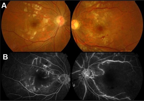 Figure 4 (A) After sub-Tenon’s injection of triamcinolone acetonide 50 mg/week in both eyes for 3 weeks, there were obviously decreasing soft exudates in the macula in both eyes. (B) At the late phase in the macula, there was less perivascular leakage in each eye and a smaller capillary nonperfusion area in the right eye.