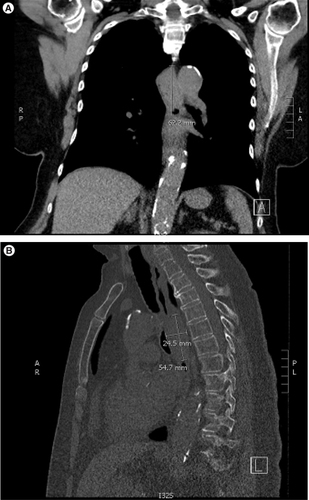 Figure 1. Computed tomography images of esophageal mass.( A) Coronal images of thorax. ( B) Sagittal images of thorax. Arrows indicate esophageal mass. Measure bars recorded in ml.