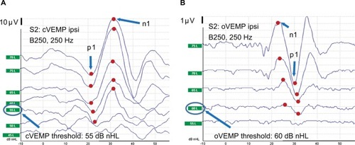 Figure 4 Typical clinically viable cervical vestibular evoked myogenic potential (cVEMP) (A) and ocular vestibular evoked myogenic potential (oVEMP) (B) responses from ipsilateral (ipsi) side using 250 Hz burst stimulation with B250 in subject S2.