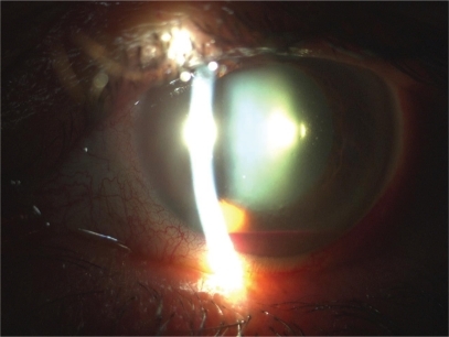 Figure 3 Patient with a moderate hyphema.