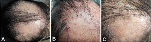 Figure 1 Clinical manifestations of the patient. (A) Two symmetrical cicatricial alopecia patches on the scalp; (B) Recurrent follicular papules, pustules, and hemorrhagic crusts in the early stage (photographed by the patient herself); (C) Perifollicular erythema, keratosis, scales, and follicular tufts in the late stage.