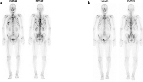 Figure 2 Bone scintigraphy (a) At the time of MM diagnosis. Abnormal accumulations are noted in the right sternum, left temporal bone, sternum, cervical-thoracic-lumbar-sacral vertebrae, left and right ilia, and right ischium. (b) After the completion of nine courses of DPd therapy. 1 year after the initiation of MM treatment. Although some residual accumulations are noted, the multiple abnormal accumulations observed previously have improved, suggesting that they were associated with pathological fractures caused by MM, rather than MM lesions themselves.