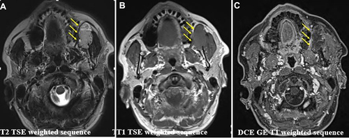 Figure 2 MRI findings of our representative case of a 54-year-old man with MT in left buccal space. (A) Axial T2 sequence showed a well circumscribed solid oval mass (yellow arrows) with intermediate signal intensity with areas of high signal intensity and the presence of peripheral high-flow serpentine vessels. (B) Axial T1 sequence showed low signal intensity of the oval lesion (yellow arrows). (C) The mass (yellow arrows) showed a non-enhancing area with enhancing vessels after intravenous contrast administration.