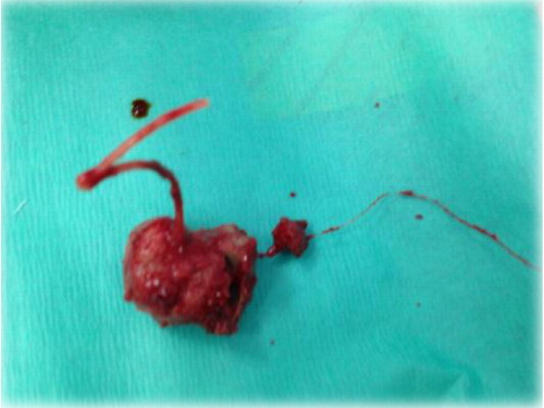 Fig. 4 Calcified IUCD after removal.