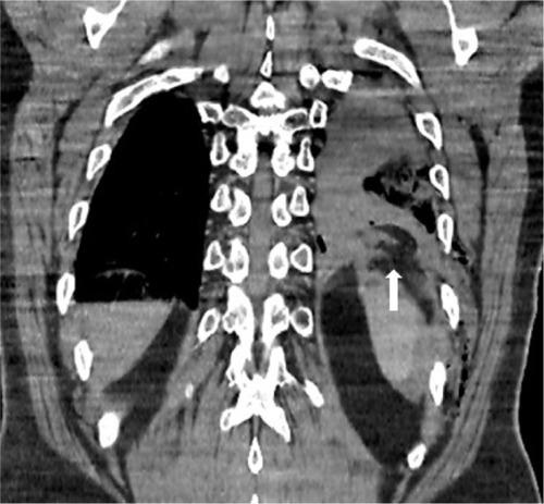 Figure 4 A 36-year-old man with penetrating trauma