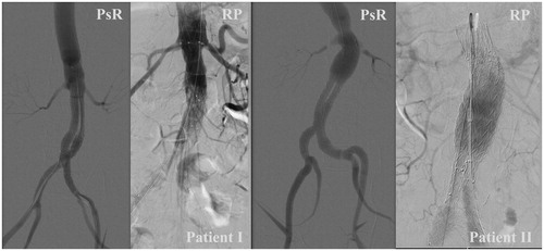 Figure 2. Final angiograms of the PsR and the real procedure (RP) for two patients: one that ended with primary technical success (patient I) and the one that ended with assisted primary technical success (patient II).