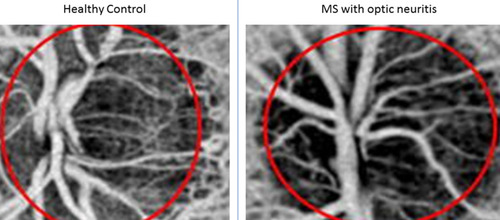 Figure 1 Left Side: Disc OCT-A of a healthy control subject. Right side: Disc OCT-A of an optic neuritis disc showing reduced density of the optic nerve head blood vessel network. This implies reduced blood flow on the optic nerve head.