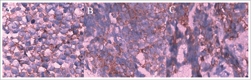 Figure 8. Immunohistochemical staining confirmed CgA, NSE, Syn as positive.