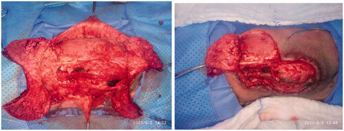 Figure 2. The rotation flaps are dissected below the muscular fascia level.