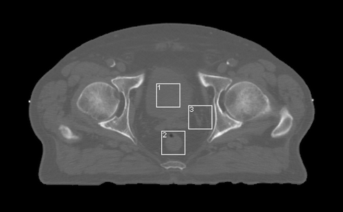 Figure 2.  Axial CT image through the pelvis showing: 1. Bladder, 2. Rectum, 3. Other. The image was acquired using a 3mm slice thickness with a pixel size in the image plane of 0.977 mm.
