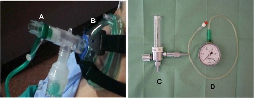 Figure 3 Equipment needed for continuous positive airway pressure Boussignac technique.