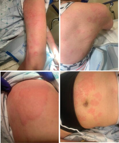 Figure 1. Urticaria was present on the patient on presentation, characterized by diffuse, erythematous, and blanchable wheals involving the superficial dermis. (Top left, clockwise) Urticarial wheals were present on the patient’s arms, back, abdomen, and shoulders.