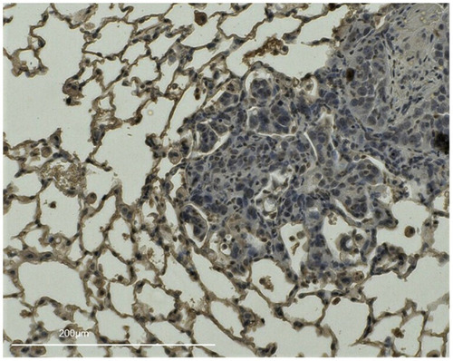 Figure 5 IHC staining of ICAM-1 in a smoking mouse lung with pulmonary metastasis, Lung tissues from the largest longitudinal section in the right lobe of a smoking group mouse injected with CMT-93 cells on the 15th day of smoking exposure were stained for ICAM-1. There are some pulmonary metastases surrounded by areas enhanced with ICAM-1.