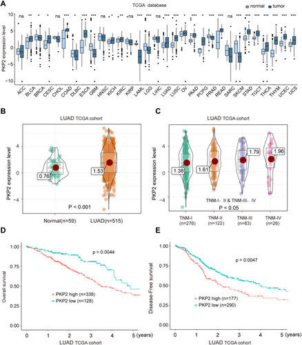 Figure 3 High expression of PKP2 indicates unfavorable outcome of LUAD patients in TCGA cohort. (A) The mRNA expression of PKP2 in a series of tumor tissues and the corresponding normal tissues was analyzed in TCGA database. (B) The mRNA expression of PKP2 in LUAD tissues and normal control tissues was analyzed in TCGA LUAD cohort. (C) The mRNA expression of PKP2 in LUAD patients at different TNM stages was analyzed in LUAD TCGA cohort. (D and E) Kaplan–Meier analysis was performed to analyze the OS and DFS in LUAD patients with low or high-expression of PKP2. *P < 0.05, **P < 0.01, ***P < 0.001.