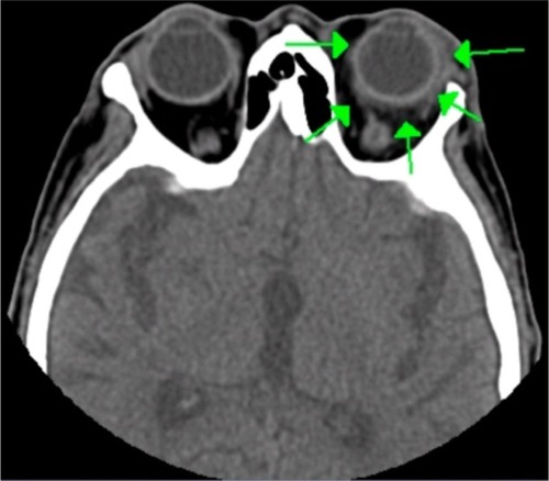 Figure 4 Computed tomographic image showing the presence of orbital cellulitis.