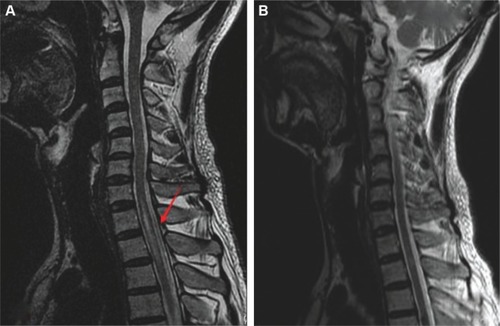 Figure 1 (A) T2-weighted sagittal magnetic resonance image of the cervical and thoracic spinal cord without contrast medium showing a hyperintense lesion with swelling at C7 to T3 (arrow). (B) A follow-up spinal magnetic resonance image 3 months later showed almost complete disappearance of the original lesions.