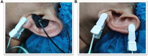 Figure 1 Stimulation sites in the taVNS group (A) and the SS group (B).