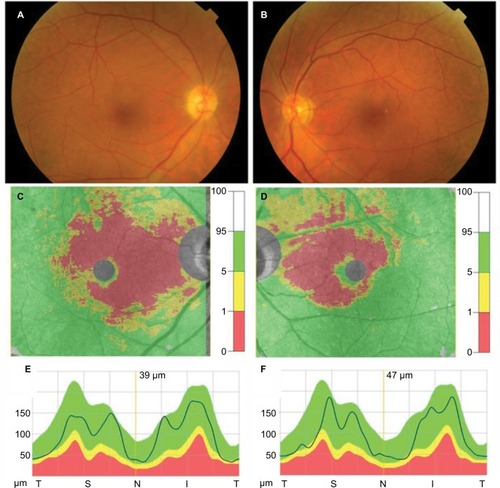 Figure 3 Fundus photographs and results of measurement of the macular GCC and cpRNFL obtained from Case 3.