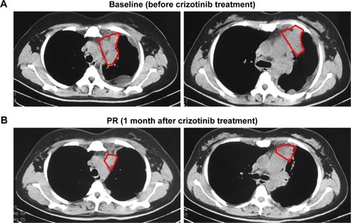 Figure 1 Responses of a CD74–ROS1 fusion patient with pulmonary blastoma to crizotinib.
