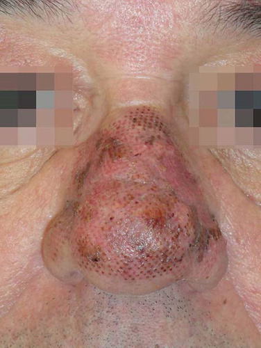 Figure 3. Marked improvement of cystic lesions 3 months after laser treatment.