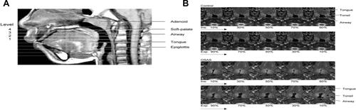 Figure S7 (A) Midsagittal magnetic resonance image demonstrating the four ascending levels for analysis (thick dotted lines). Level 1 is 4 mm above tip of epiglottis. (B) Dynamic changes in cross-sectional area at midtonsillar level (level 2) during tidal breathing (5-vol increments of inspiration [ins], 5-vol increments of expiration [Exp]) of control subjects (top panels) and subjects with OSAS (bottom panels). Note difference in anteroposterior (A-P) and lateral airway dimension.Note: Reprinted with permission of the American Thoracic Society. Copyright © 2020 American Thoracic Society. Arens R, Sin S, McDonough JM, Palmer JM, Dominguez T, Meyer H, et al. 2005. Changes in upper airway size during tidal breathing in children with obstructive sleep apnea syndrome. Am J Respir Crit Care Med. 171. 1298–304. Official journal of the American Thoracic Society.Citation125