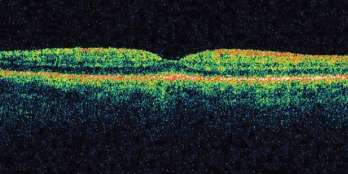 Figure 3 An OCT scan of the right eye at initial presentation. There was some thickening of the RPE layer but there were no signs of any retinal oedema or serous detachment.