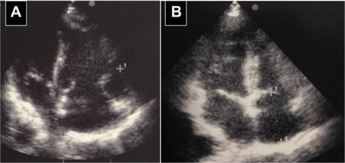 Figure 3 A 43-year-old woman admitted to the hospital presenting with acute dyspnea, tachycardia, and hypotension.