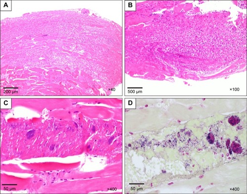 Figure 3 Pathological findings of excised skeletal muscle and fascia.