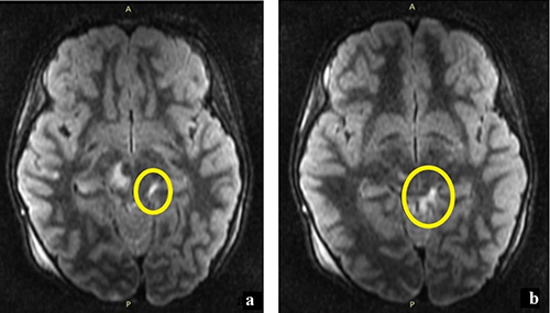 Figure 7 An 8-year-old patient, motor vehicle accident. (a and b) The left ambient cistern has a high-intensity FLAIR signal (yellow circle) suggestive of traumatic subarachnoid hemorrhage.