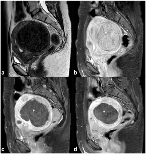 Figure 8. A 47-year old woman with a large uterine fibroid of Funaki type 1 (largest diameter 9.4 cm) and fibroid-associated symptoms was treated by US-guided HIFU at our institution. Representative MRI images (a T2-w, b–d contrast-enhanced T1-w, sagittal plane) of the large uterine fibroid pre- and post-procedure are shown. At baseline, the fibroid volume was about 300 ml in T2-w (a) and 275 ml in T1-w MRI (b). Three hours after HIFU procedure, the treated fibroid was unchanged in size and volume, but largely nonvascularized (c: black region, marked with a white star): a non-perfused volume ratio of 73% was achieved indicating an effective ablation and technical success. Three months after US-guided HIFU, a considerable volume reduction of about 50% was observed (fibroid volume in T1-w MRI of 153 ml, d; largest diameter 7.4 cm).