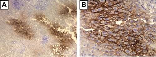 Figure 5 Immunostaining with p1B3 of normal liver tissue with moderate steatosis of a 75-year-old individual who underwent subtotal hepatectomy because of a car accident trauma, shows cell membrane signal with increasing intensity towards central vein regions. A) ×40, B) ×200.