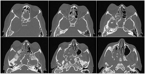 Figure 2. Preoperative computed axial tomography with contrast. CT prior to optic nerve decompression demonstrated irregular sclerosis, fragmentation and expansion of the walls of the right maxillary and sphenoid sinuses, right greater wing of the sphenoid, and right pterygoid body. In addition, enlargement of the right lateral rectus muscle was observed in the inferolateral extraconal compartment of the right orbit extending posteriorly and resulting in compression of the right optic nerve near the orbital apex.