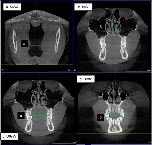 Figure 3 Measurements of the upper airway variables in CBCT images: transverse dimension variables of oral cavity variables in CBCT images.