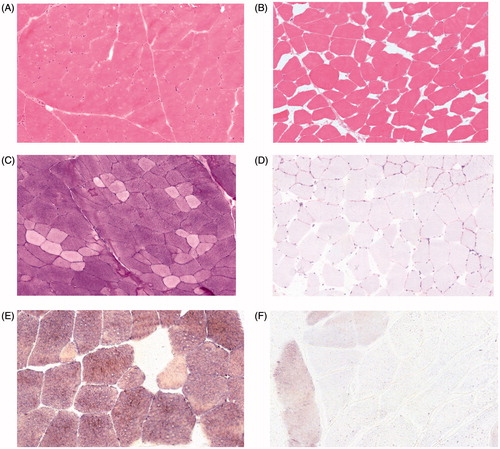 Figure 2. Morphology of thermal damage (B, D, F) in comparison to undamaged muscle (A, C, E). (A) Physiological structure of undamaged muscle stained with H&E (100×). (B) Widening of intercellular spaces in damaged muscle areas (100×). (C) Strong Periodic acid Schiff (PAS) signal in undamaged myocytes (100×). (D) Loss of PAS reaction in damaged myocytes (100×). (E) Strong myophosphorylase activity in undamaged myocytes (200×). (F) Loss of myophosphorylase activity in the damaged area (200×). Note that in A, C and E generally no extracellular space is visible and the cellular structure is well preserved. In contrast, in B, D and F the extracellular space is widened.