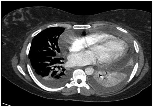 Figure 2. Chest CT with contrast Day 14: large pericardial effusion with pericardial thickening and hyper-enhancement. Bilateral pleural effusions with adjacent lower lobe atelectasis.