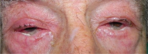 Figure 3 Bilateral eyelid dermatitis and lower lid entropion in a 90-year-old male patient treated with Cosopt and Lumigan (prostaglandin analog) in both eyes for 4 years.