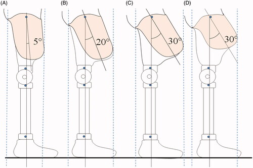 Figure 6. shows different degrees of transtibial socket flexion and path of the weight line dropping from mid socket and passing through the ankle. The distance between the 2 dotted lines shows the bulkiness of the socket in which the greatest distance is the bulkiest prosthesis. For the same residual limb length, the bulkiest is the most flexed socket (C > B > A), and for the same angle, it is the longer residual limb length (C > D).
