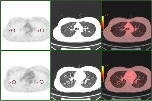 Figure 1 Representative ROIs of the lung on the 18F-FDG PET/CT. Circular ROIs were drawn on the lateral peripheral regions of the RUL, RLL, LUL, and LLL.
