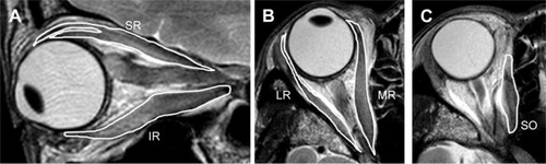 Figure 2 Measurement of the cross-sectional areas of extraocular muscles on T2-weighted images.