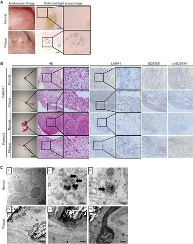 Figure 7. Impaired autophagic flux in mucosa with plaques compared with that in normal mucosa in kidney stone formers. (A) Kidney mucosa biopsy samples obtained from normal and plaque-covered areas of CaOx stone formers were analyzed. Endoscopic- and polarized-light scope images of the mucosa of plaque-covered and normal areas are shown. (B) These mucosa samples were stained with hematoxylin and eosin (HE) and immunostained for LAMP1, SQSTM1, and p-SQSTM1. (C) TEM images of the mucosa in plaque-covered and normal areas are shown. Scale bars: 1 mm (B), 100 μm (A), 5 μm (C; I and IV) and 0.5 μm (C; II, III, V, VI). Arrows indicate autolysosomes. L, lysosome; C, crystal.