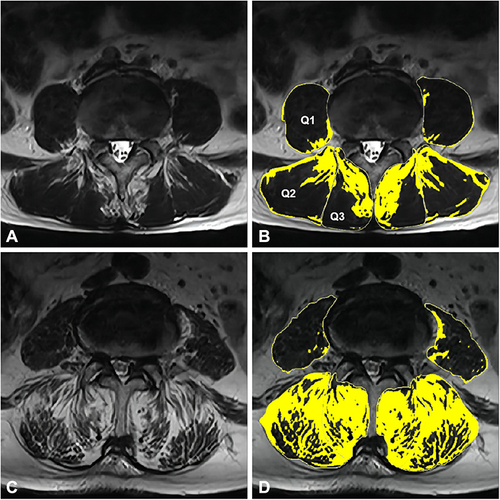 Figure 1 Typical L4-L5 axial images.