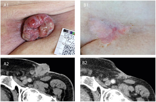 Figure 1. Tumour response to calcium electroporation and pembrolizumab. (A1) Clinical photograph of the left inguinal region prior to initial instatement of CaEP, showing clinical progression of recurring inguinal lymph node metastasis during first bout of pembrolizumab. (A2) Contrast-enhanced CT-scan axial view at the level of the left inguinal region, performed at approximately the same time as the clinical photograph in A1, confirming progression of lymph node metastasis. (B1) Clinical photograph of the left inguinal region following four treatments of local calcium electroporation and second bout of pembrolizumab, showing complete clinical response. (B2) Contrast-enhanced CT-scan axial view at the level of left inguinal region, performed at approximately the same time as the clinical photograph in B1, showing regression of both the exophytic and deeper seated parts of the lymph node metastases.