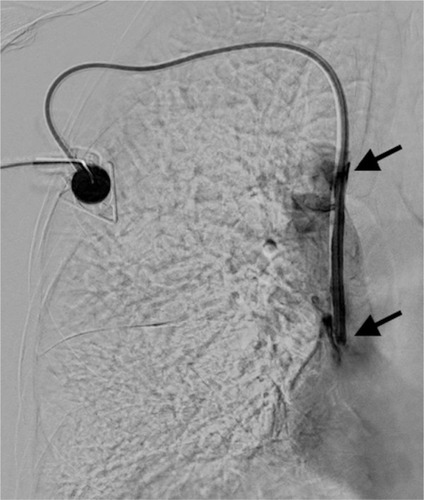Figure 1 Digital subtraction angiography of clinically dysfunctional venous port system correctly placed into the cavoatrial junction.