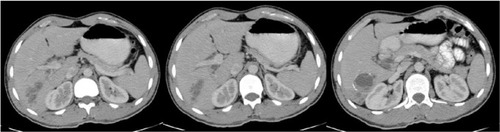 Figure 2 A 20-year-old male with pain in the right upper abdomen.