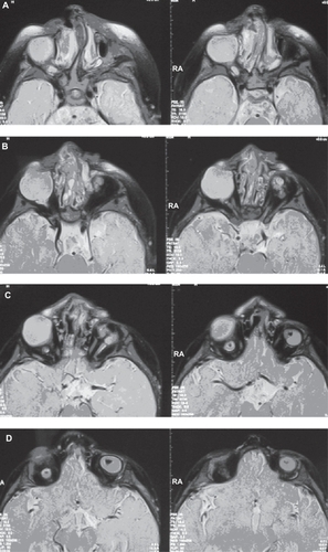 Figure 4 A–D Magnetic resonance imaging of the orbits of case 1.