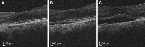 Figure 2 Optical coherence tomography of the 71-year-old woman with polypoidal choroidal vasculopathy.Notes: (A) Seven months after initial intravitreal injections of ranibizumab, logMAR BCVA was 0 and CMT was 251 μm. (B) Ten months after initial intravitreal injections of ranibizumab, logMAR BCVA was −0.079 and CMT was 291 μm. (C) Fourteen months after initial intravitreal injections of ranibizumab, logMAR BCVA was logMAR −0.041 and CMT was 381 μm.