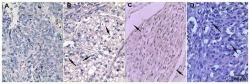 Figure 4 Immunohistochemistry staining of TRPC6 protein expressed in human cervical carcinoma tissues (100×). (A) There was little to no cell membrane staining when the primary antibody was substituted with phosphate-buffered saline. (B) More than 50% cells stained positive for TRPC6, cell membrane staining was seen at the arrow. (C) TRPC6-stained sample with vascular wall invasion, which was indicated at the arrow. (D) Hematoxylin and eosin staining sample with nuclear atypia at the arrow.