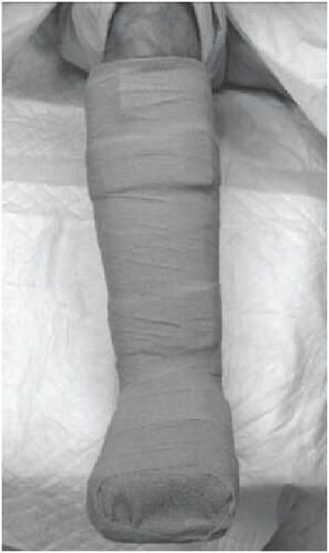 Figure 7b Instant total contact cast: made by wrapping the removable cast walker with a layer of cohesive bandage.