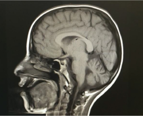 Figure 2. MRI showing cerebellar atrophy.